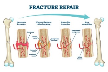 Bonfracture
